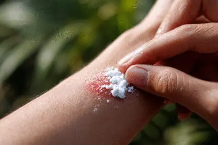 Ruka nanosi umirujuću pastu na crveni ugriz kukca kao brza metoda za ublažavanje svrbeža od ugriza stjenice