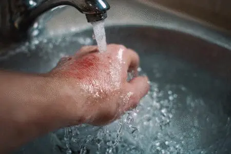 Ruka s opeklinom drži se pod mlazom hladne vode kao prikaz prve pomoći kod opeklina od vrele vode