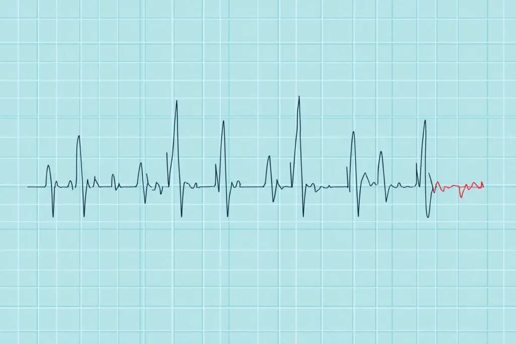 Kako očitati EKG nalaz tumačenje linija na elektrokardiogramu