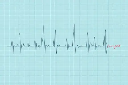 Kako očitati EKG nalaz tumačenje linija na elektrokardiogramu