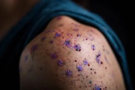 Klinički prikaz kože s brojnim malim neobjašnjivim modricama kao simptom koji može ukazivati na leukemiju