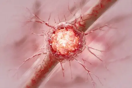 Medicinska ilustracija teškog ugriza pauka s mjehurićem i velikim crvenilom kao prikaz opasnih simptoma