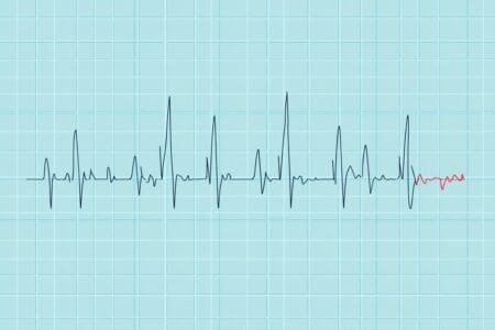 Kako očitati EKG nalaz tumačenje linija na elektrokardiogramu